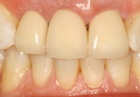 Dentures - image 03.02.04-8 on https://www.wollicreekdental.com.au
