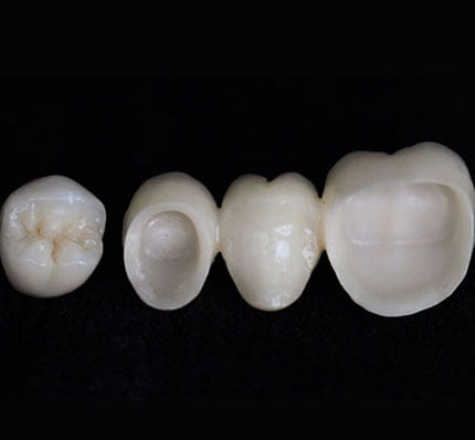 Dental Crowns