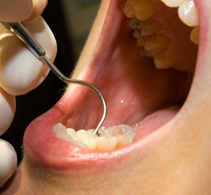 Periodic Examination Tooth Decay